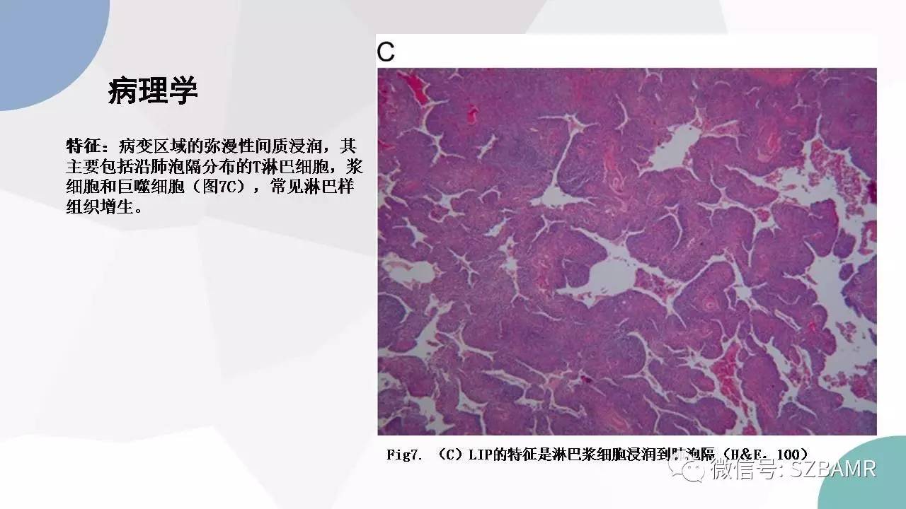 【PPT】特发性间质性肺炎的影像与病理
