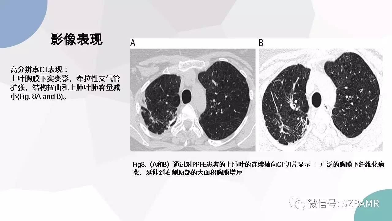 【PPT】特发性间质性肺炎的影像与病理
