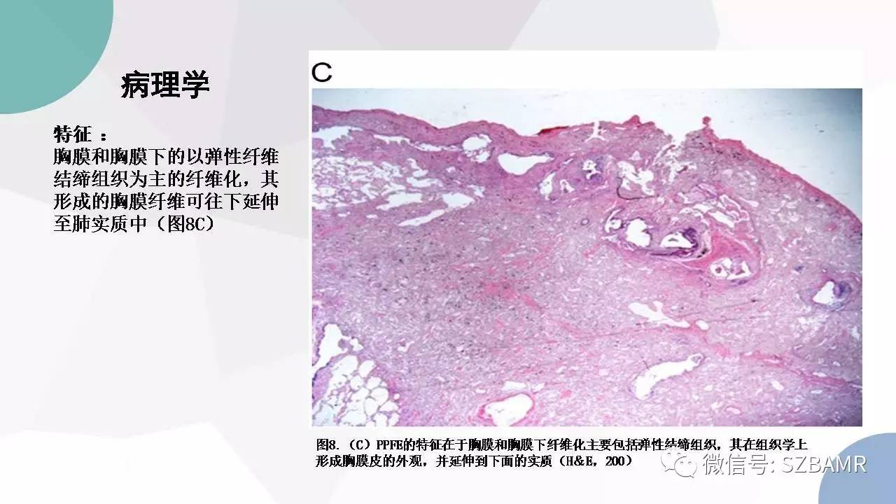 【PPT】特发性间质性肺炎的影像与病理