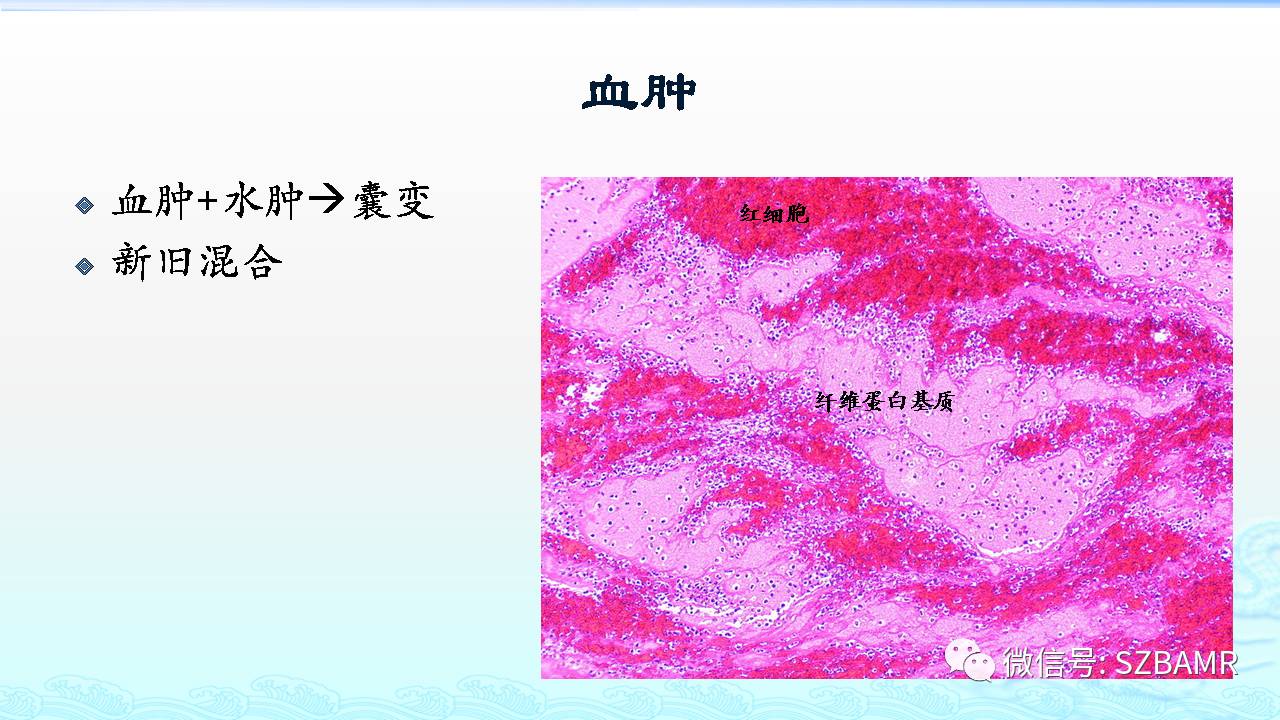 【PPT】脑出血(MR信号)演变——通俗记忆法