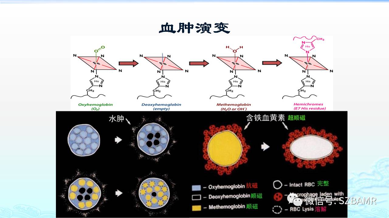 【PPT】脑出血(MR信号)演变——通俗记忆法