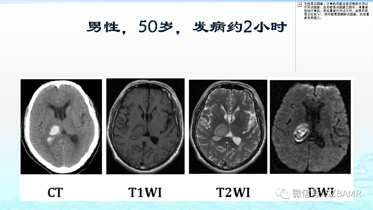 【PPT】脑出血(MR信号)演变——通俗记忆法