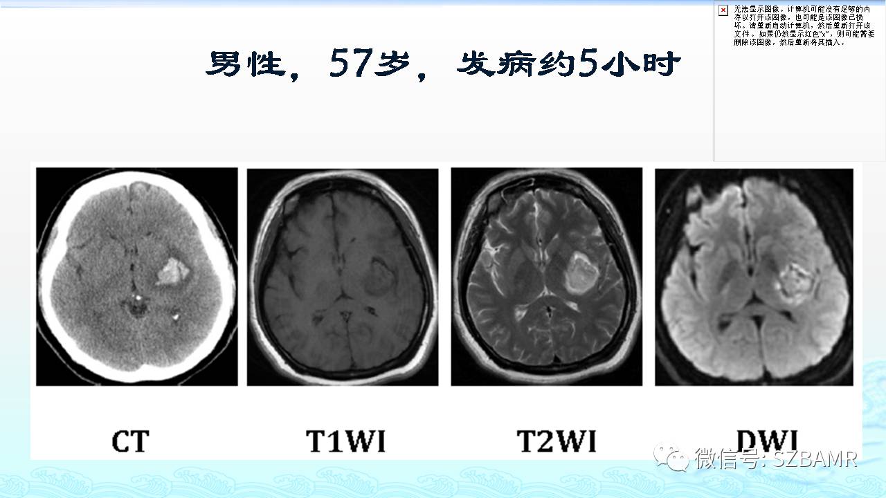 【PPT】脑出血(MR信号)演变——通俗记忆法