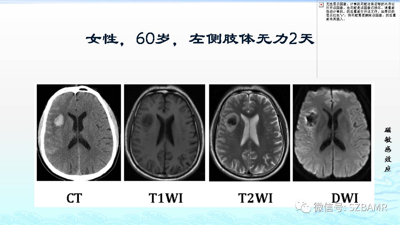 【PPT】脑出血(MR信号)演变——通俗记忆法