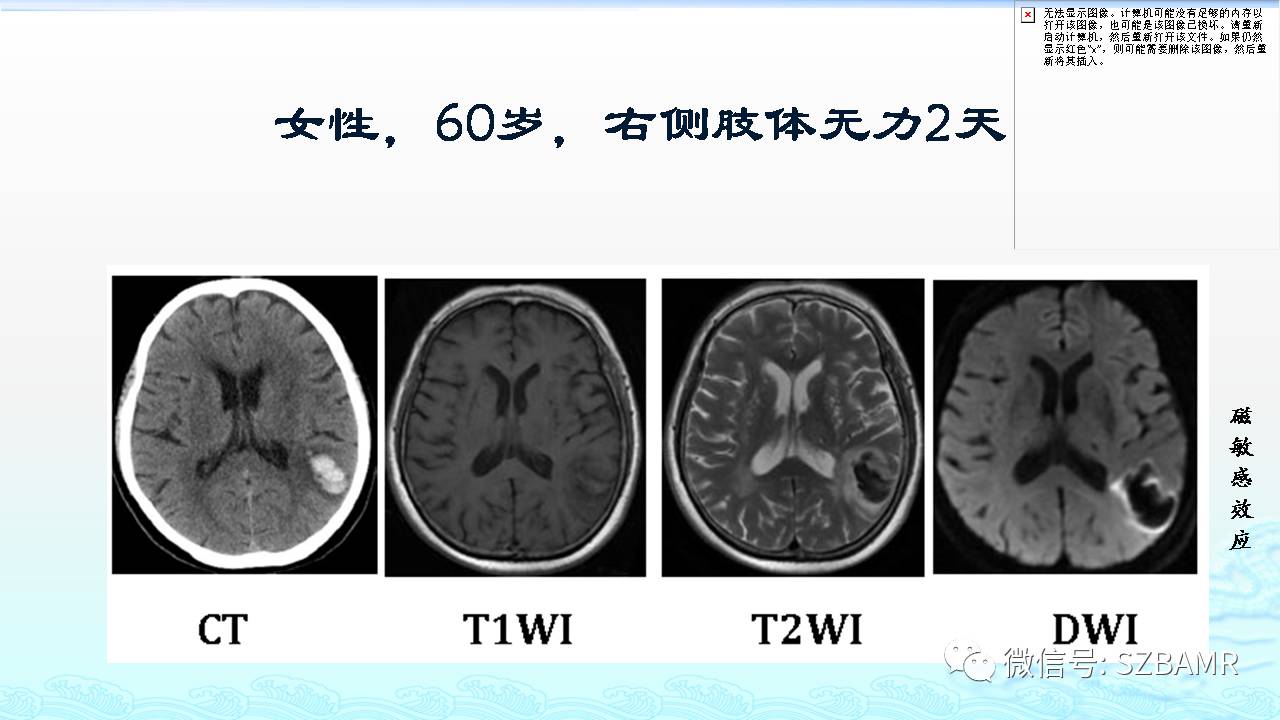 【PPT】脑出血(MR信号)演变——通俗记忆法