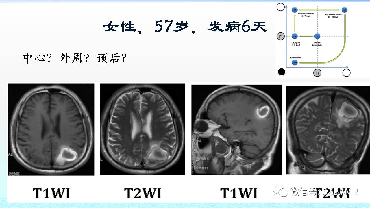 【PPT】脑出血(MR信号)演变——通俗记忆法