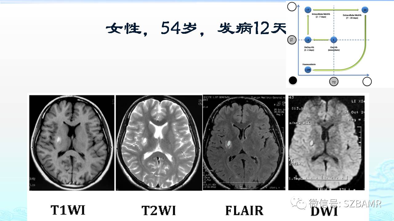 【PPT】脑出血(MR信号)演变——通俗记忆法