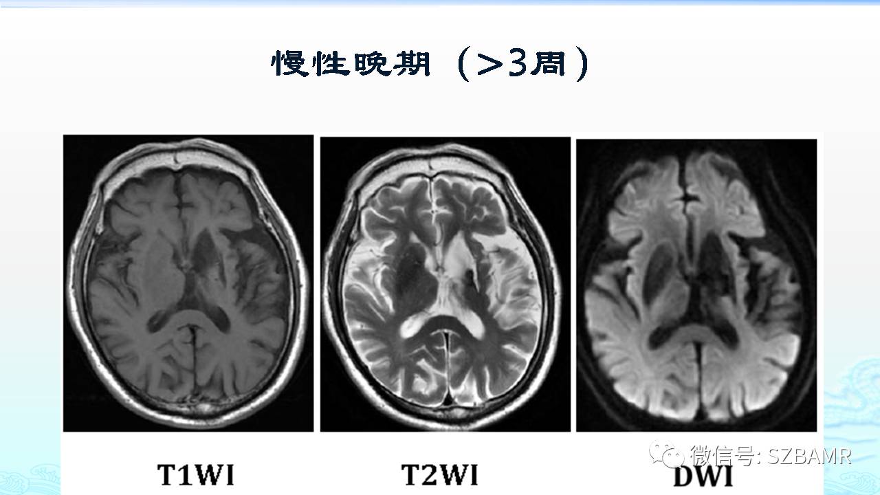 【PPT】脑出血(MR信号)演变——通俗记忆法