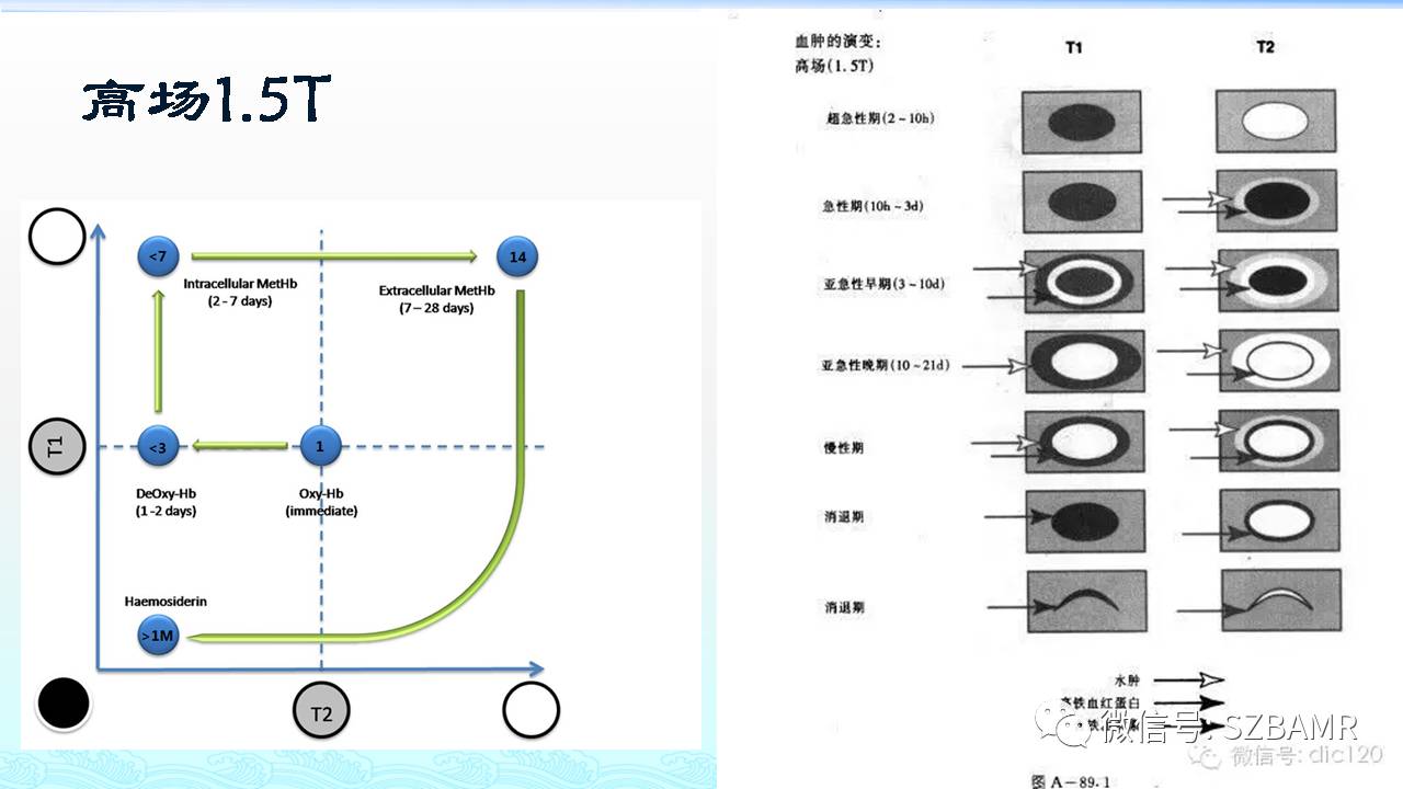 【PPT】脑出血(MR信号)演变——通俗记忆法