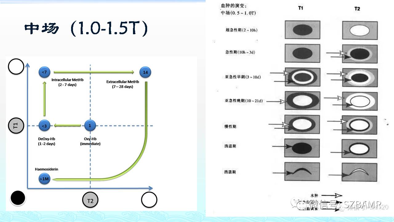 【PPT】脑出血(MR信号)演变——通俗记忆法