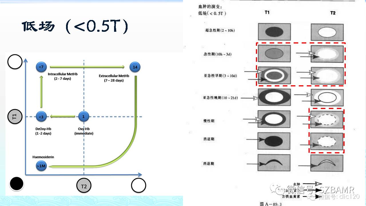 【PPT】脑出血(MR信号)演变——通俗记忆法