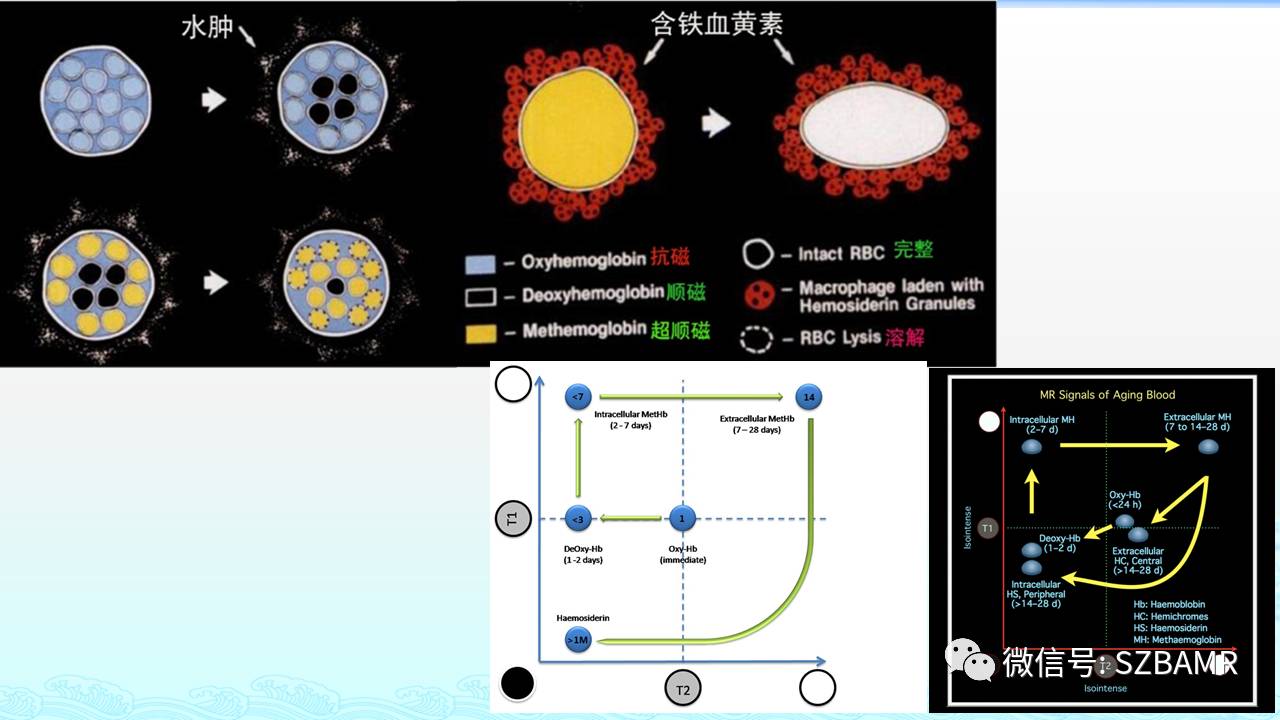 【PPT】脑出血(MR信号)演变——通俗记忆法