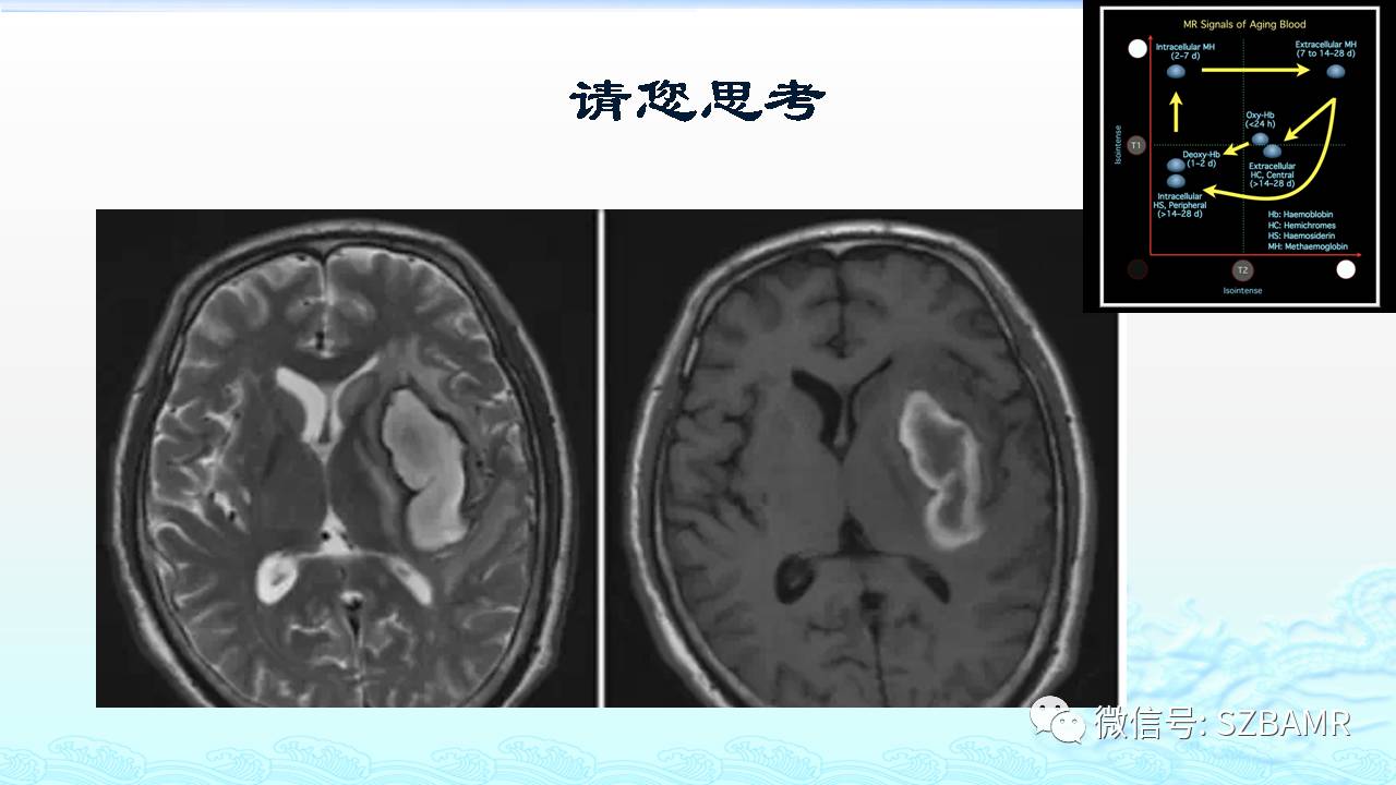 【PPT】脑出血(MR信号)演变——通俗记忆法