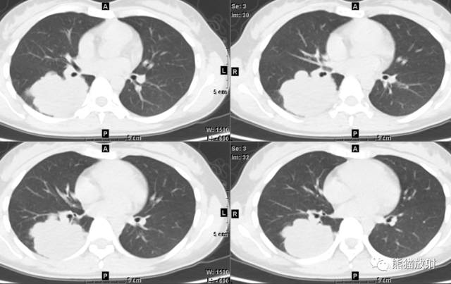 【病例】右肺下叶浸润性腺癌1例CT