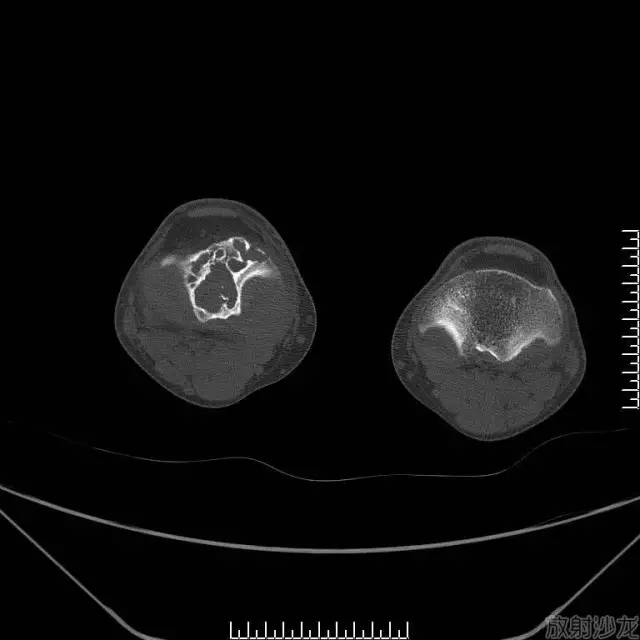 【病例】软骨母细胞型骨肉瘤1例 【病例】软骨母细胞型骨肉瘤1例