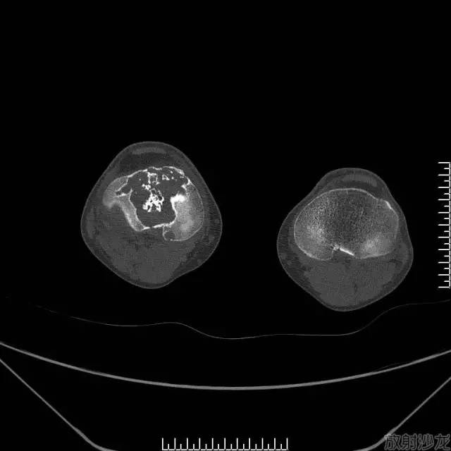 【病例】软骨母细胞型骨肉瘤1例 【病例】软骨母细胞型骨肉瘤1例