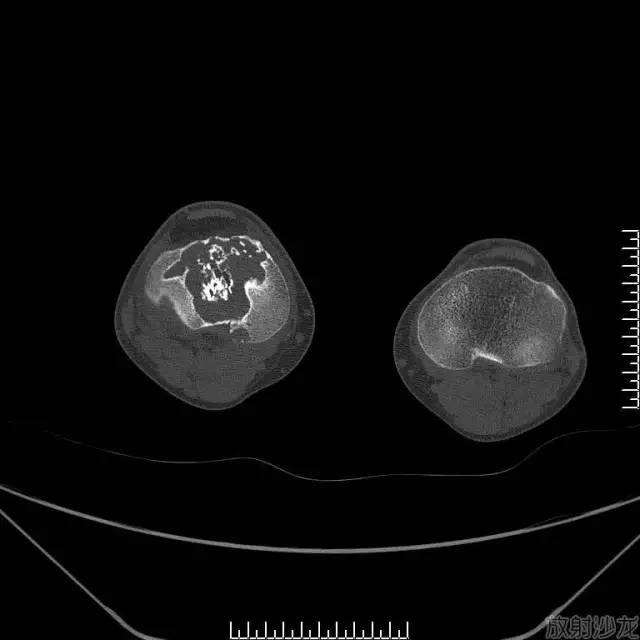 【病例】软骨母细胞型骨肉瘤1例 【病例】软骨母细胞型骨肉瘤1例