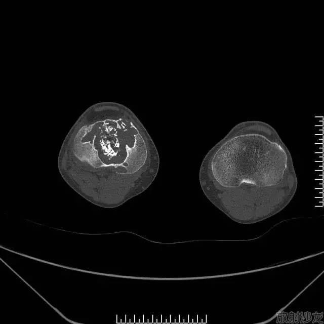 【病例】软骨母细胞型骨肉瘤1例 【病例】软骨母细胞型骨肉瘤1例