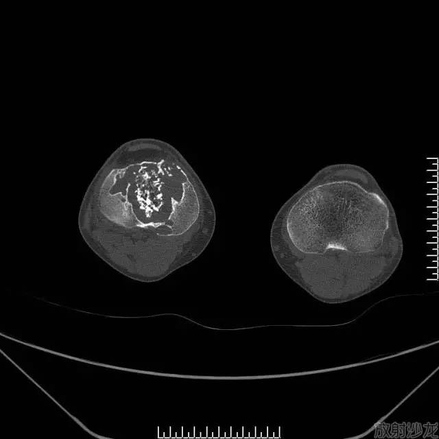 【病例】软骨母细胞型骨肉瘤1例 【病例】软骨母细胞型骨肉瘤1例