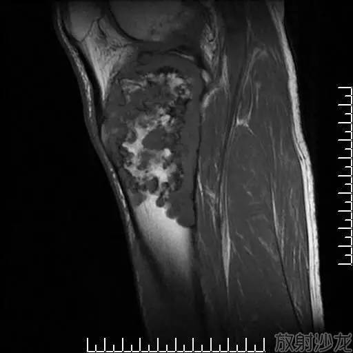 【病例】软骨母细胞型骨肉瘤1例 【病例】软骨母细胞型骨肉瘤1例