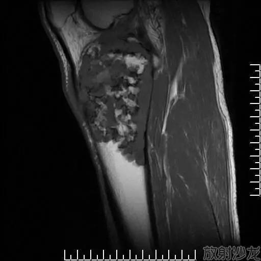 【病例】软骨母细胞型骨肉瘤1例 【病例】软骨母细胞型骨肉瘤1例