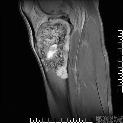 【病例】软骨母细胞型骨肉瘤1例 【病例】软骨母细胞型骨肉瘤1例