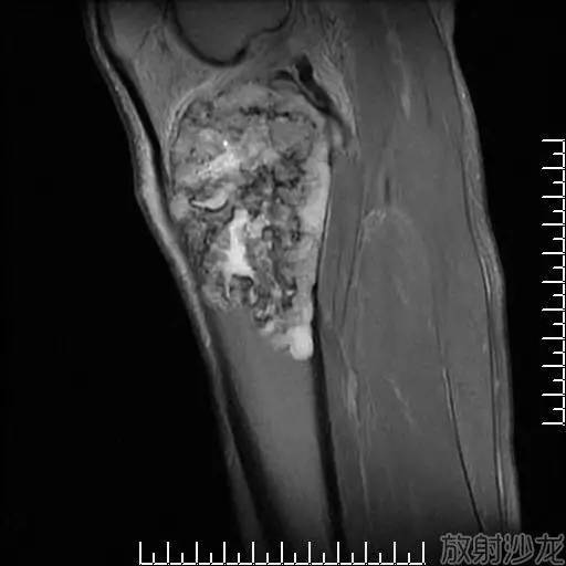 【病例】软骨母细胞型骨肉瘤1例 【病例】软骨母细胞型骨肉瘤1例