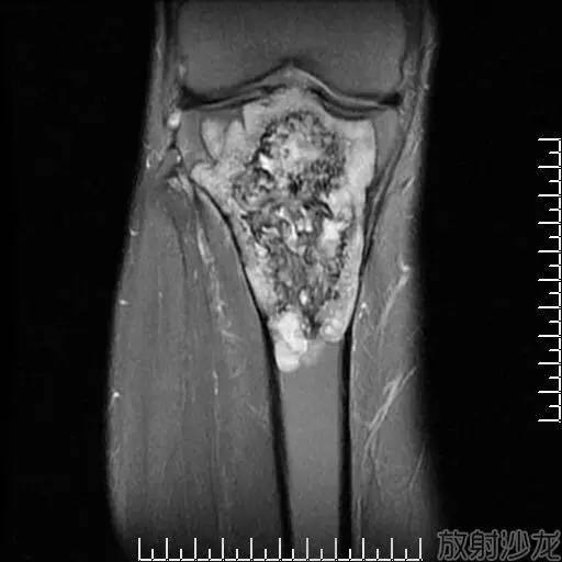 【病例】软骨母细胞型骨肉瘤1例 【病例】软骨母细胞型骨肉瘤1例