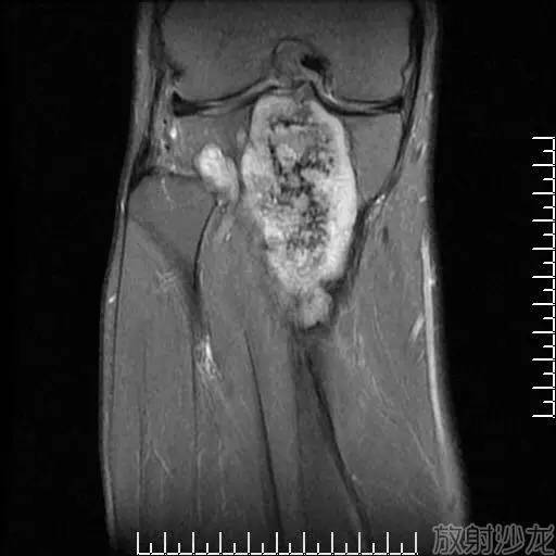 【病例】软骨母细胞型骨肉瘤1例 【病例】软骨母细胞型骨肉瘤1例