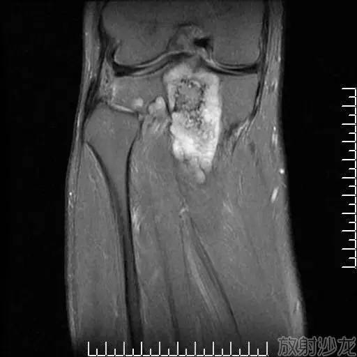 【病例】软骨母细胞型骨肉瘤1例 【病例】软骨母细胞型骨肉瘤1例