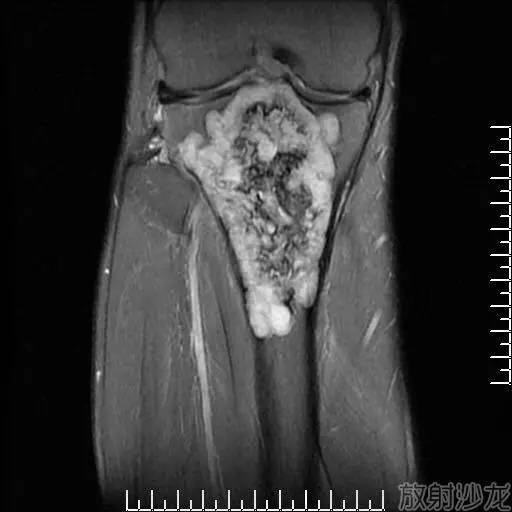 【病例】软骨母细胞型骨肉瘤1例 【病例】软骨母细胞型骨肉瘤1例