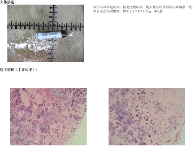 【病例】软骨母细胞型骨肉瘤1例 【病例】软骨母细胞型骨肉瘤1例