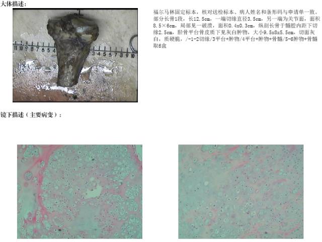【病例】软骨母细胞型骨肉瘤1例 【病例】软骨母细胞型骨肉瘤1例