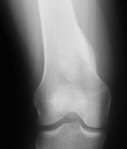 【病例】骨旁骨肉瘤1例X线CT影像诊断思路 【病例】骨旁骨肉瘤1例X线CT影像诊断思路