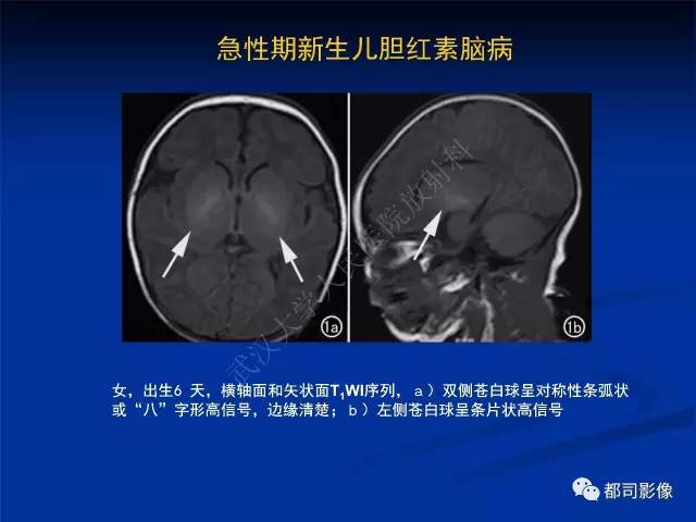 【PPT】新生儿胆红素脑病与糖代谢异常脑损伤影像表现