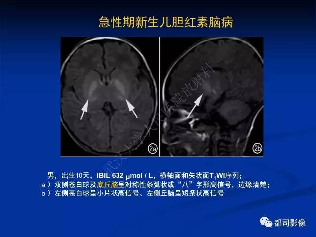 【PPT】新生儿胆红素脑病与糖代谢异常脑损伤影像表现
