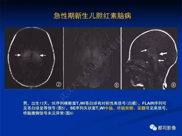【PPT】新生儿胆红素脑病与糖代谢异常脑损伤影像表现