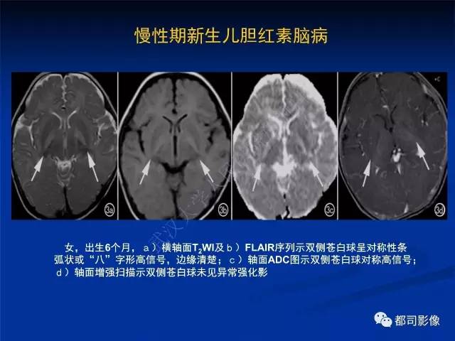 【PPT】新生儿胆红素脑病与糖代谢异常脑损伤影像表现