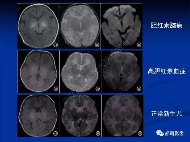 【PPT】新生儿胆红素脑病与糖代谢异常脑损伤影像表现