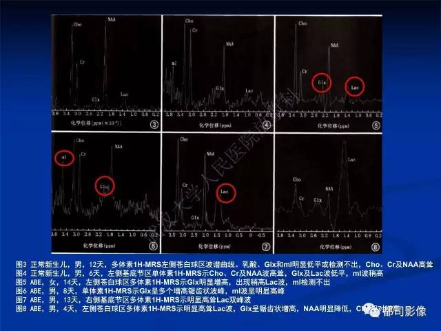 【PPT】新生儿胆红素脑病与糖代谢异常脑损伤影像表现