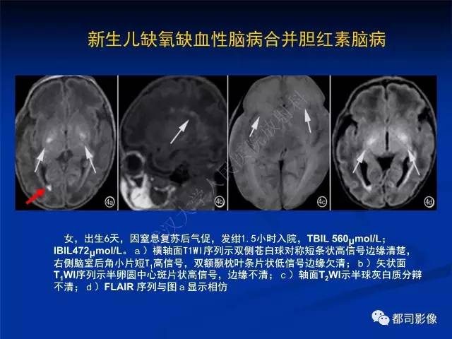 【PPT】新生儿胆红素脑病与糖代谢异常脑损伤影像表现