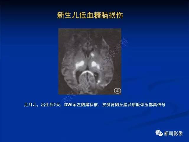 【PPT】新生儿胆红素脑病与糖代谢异常脑损伤影像表现