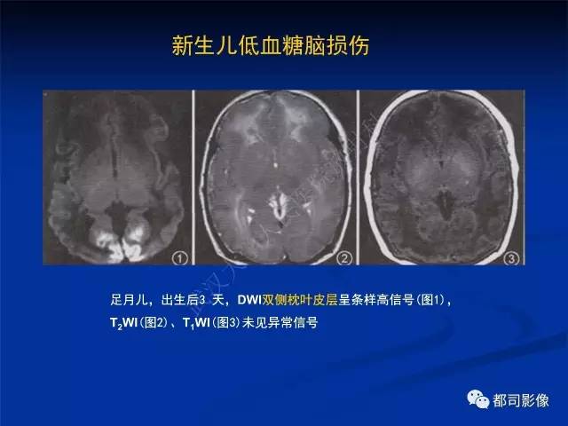 【PPT】新生儿胆红素脑病与糖代谢异常脑损伤影像表现