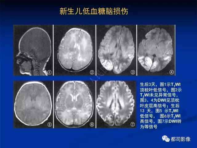 【PPT】新生儿胆红素脑病与糖代谢异常脑损伤影像表现