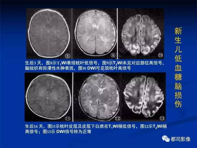 【PPT】新生儿胆红素脑病与糖代谢异常脑损伤影像表现