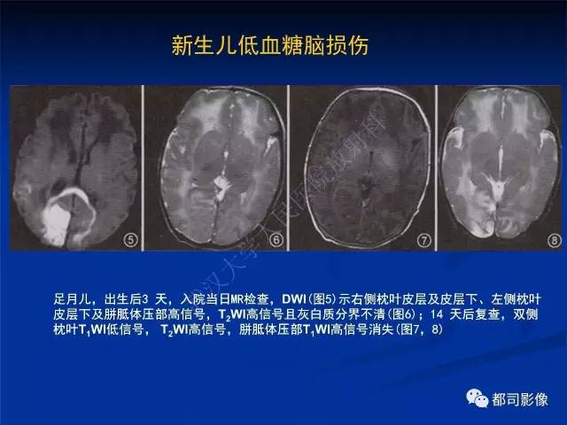 【PPT】新生儿胆红素脑病与糖代谢异常脑损伤影像表现