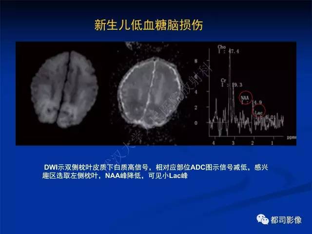 【PPT】新生儿胆红素脑病与糖代谢异常脑损伤影像表现