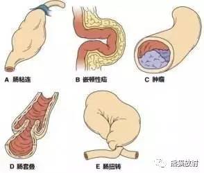 胃肠道急腹症必须搞清楚的几个问题