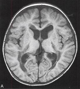 【病例】肾上腺脑白质营养不良1例MR影像表现 【病例】肾上腺脑白质营养不良1例MR影像表现