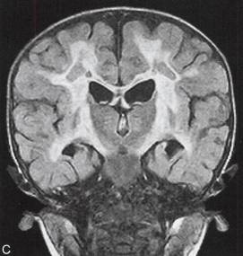 【病例】肾上腺脑白质营养不良1例MR影像表现 【病例】肾上腺脑白质营养不良1例MR影像表现